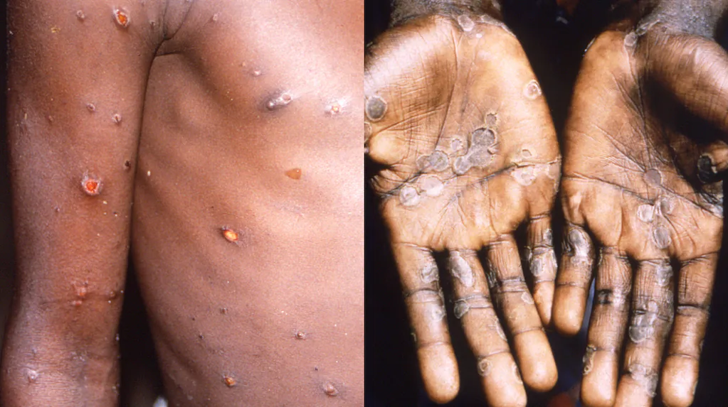 Alerta sanitaria | El Ministerio de Salud confirmó el primer caso de la variante más agresiva de la viruela del mono en Argentina y pidió reforzar la vigilancia